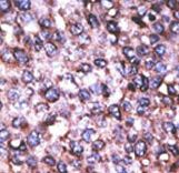 Formalin-fixed and paraffin-embedded human cancer tissue reacted with the primary antibody, which was peroxidase-conjugated to the secondary antibody, followed by AEC staining. This data demonstrates the use of this antibody for immunohistochemistry; clinical relevance has not been evaluated. BC = breast carcinoma; HC = hepatocarcinoma.