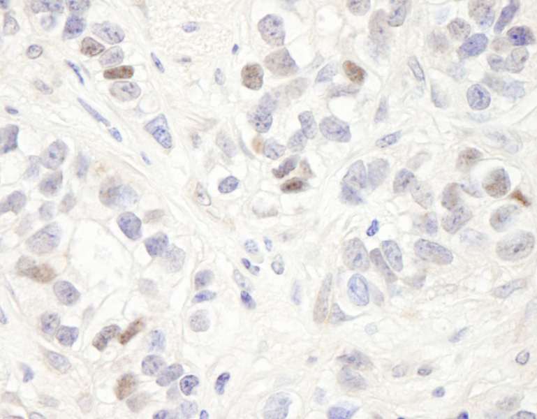 Detection of Human MAGED2 by Immunohistochemistry. Sample: FFPE section of human breast carcinoma. Antibody: Affinity purified rabbit anti-MAGED2 used at a dilution of 1:200 (1 Detection: DAB.