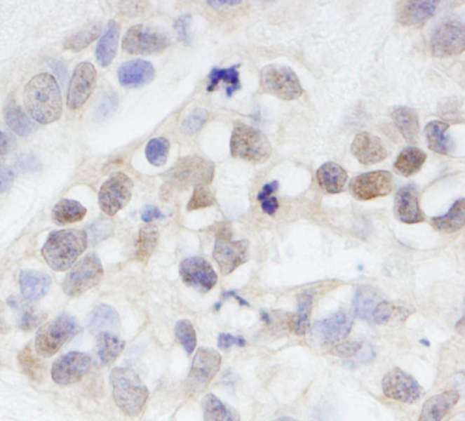 Detection of Human MAGED2 by Immunohistochemistry. Sample: FFPE section of human breast carcinoma. Antibody: Affinity purified rabbit anti-MAGED2 used at a dilution of 1:200 (1 Detection: DAB.