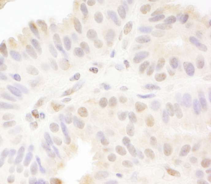 Detection of Human MAML1 by Immunohistochemistry. Sample: FFPE section of human breast carcinoma. Antibody: Affinity purified rabbit anti-MAML1 used at a dilution of 1:200 (1 Detection: DAB.