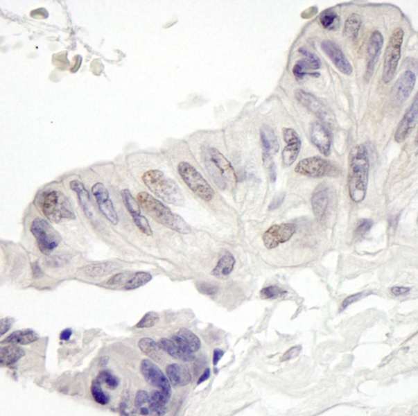 Detection of Human MAML1 by Immunohistochemistry. Sample: FFPE section of human ovarian carcinoma. Antibody: Affinity purified rabbit anti-MAML1 used at a dilution of 1:250.