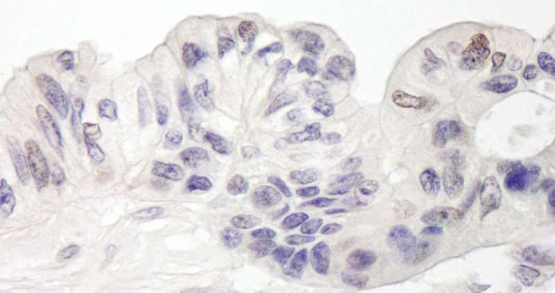 Detection of Human MAML1 by Immunohistochemistry. Sample: FFPE section of human ovarian carcinoma. Antibody: Affinity purified rabbit anti-MAML1 used at a dilution of 1:1000 (1 Detection: DAB.