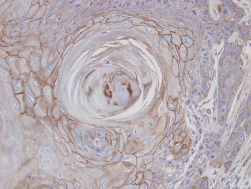 IHC of paraffin-embedded SCC25 xenograft using MAN1B1 antibody at 1:100 dilution.