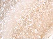 Formalin-fixed and paraffin-embedded human cancer tissue reacted with the primary antibody, which was peroxidase-conjugated to the secondary antibody, followed by DAB staining. This data demonstrates the use of this antibody for immunohistochemistry; clinical relevance has not been evaluated. BC = breast carcinoma; HC = hepatocarcinoma.