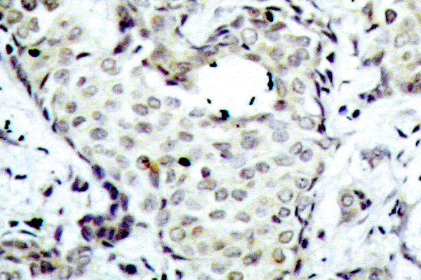 IHC of MKK6 (S201) pAb in paraffin-embedded human breast carcinoma tissue.