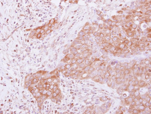 IHC of paraffin-embedded Breast ca, using GSPT1 antibody at 1:500 dilution.