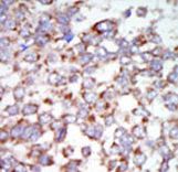 Formalin-fixed and paraffin-embedded human cancer tissue reacted with the primary antibody, which was peroxidase-conjugated to the secondary antibody, followed by AEC staining. This data demonstrates the use of this antibody for immunohistochemistry; clinical relevance has not been evaluated. BC = breast carcinoma; HC = hepatocarcinoma.