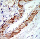 Formalin-fixed and paraffin-embedded human cancer tissue reacted with the primary antibody, which was peroxidase-conjugated to the secondary antibody, followed by DAB staining. This data demonstrates the use of this antibody for immunohistochemistry; clinical relevance has not been evaluated. BC = breast carcinoma; HC = hepatocarcinoma.