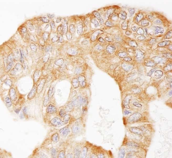 Detection of Human MAP4 by Immunohistochemistry. Sample: FFPE section of human ovarian carcinoma. Antibody: Affinity purified rabbit anti-MAP4 used at a dilution of 1:200 (1 Detection: DAB.