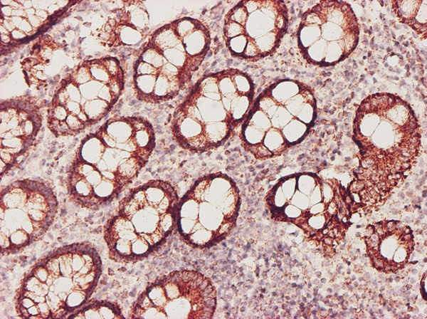 Immunoperoxidase of monoclonal antibody to GSS on formalin-fixed paraffin-embedded human colon tissue. [antibody concentration 1 ~10 ug/ml].