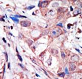 Formalin-fixed and paraffin-embedded human cancer tissue reacted with the primary antibody, which was peroxidase-conjugated to the secondary antibody, followed by AEC staining. This data demonstrates the use of this antibody for immunohistochemistry; clinical relevance has not been evaluated. BC = breast carcinoma; HC = hepatocarcinoma.