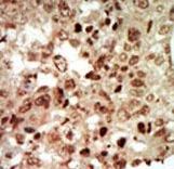 Formalin-fixed and paraffin-embedded human cancer tissue reacted with the primary antibody, which was peroxidase-conjugated to the secondary antibody, followed by AEC staining. This data demonstrates the use of this antibody for immunohistochemistry; clinical relevance has not been evaluated. BC = breast carcinoma; HC = hepatocarcinoma.