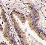 Formalin-fixed and paraffin-embedded human lung carcinoma tissue reacted with ERK4 antibody , which was peroxidase-conjugated to the secondary antibody, followed by DAB staining. This data demonstrates the use of this antibody for immunohistochemistry; clinical relevance has not been evaluated.
