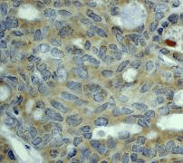 IHC of paraffin-embedded human breast carcinoma using anti-ERK3 antibody.