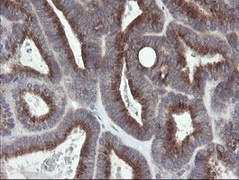 IHC of paraffin-embedded Adenocarcinoma of Human endometrium tissue using anti-GORAB mouse monoclonal antibody.
