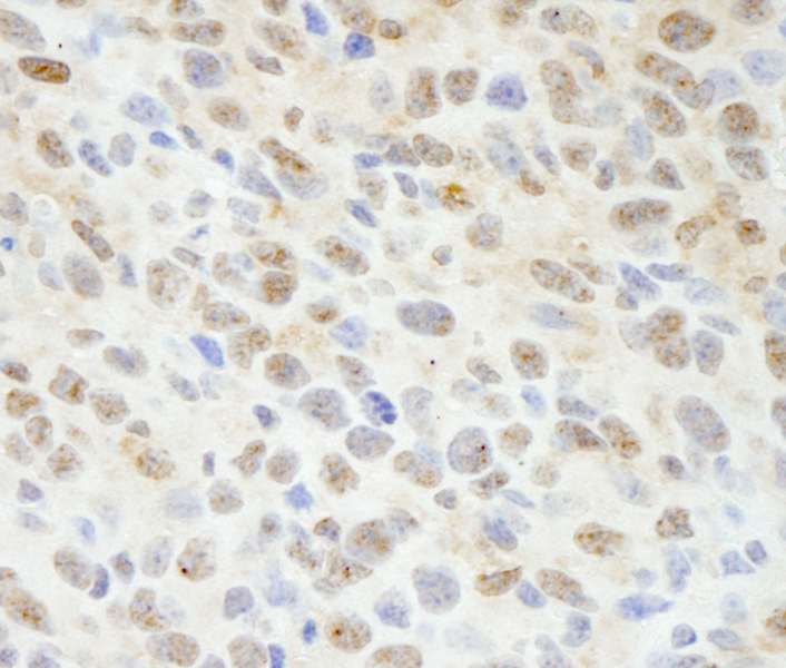 Detection of Mouse Sin1 by Immunohistochemistry. Sample: FFPE section of mouse squamous cell carcinoma. Antibody: Affinity purified rabbit anti-Sin1 used at a dilution of 1:100.