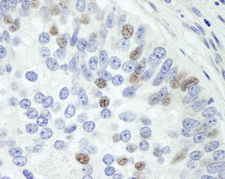 Detection of Human Sin1 by Immunohistochemistry. Sample: FFPE section of human prostate adenocarcinoma. Antibody: Affinity purified rabbit anti-Sin1 used at a dilution of 1:500.