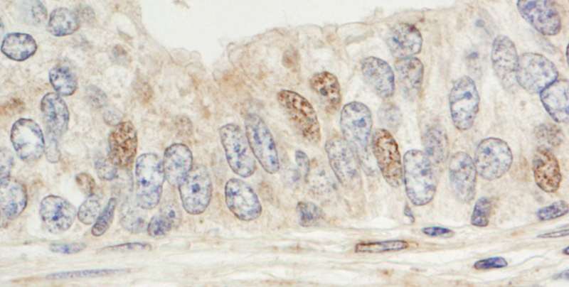 Detection of Human Sin1 by Immunohistochemistry. Sample: FFPE section of human prostate carcinoma. Antibody: Affinity purified rabbit anti-Sin1 used at a dilution of 1:1000 (1 ug/ml). Detection: DAB.