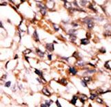 Formalin-fixed and paraffin-embedded human cancer tissue reacted with the primary antibody, which was peroxidase-conjugated to the secondary antibody, followed by DAB staining. This data demonstrates the use of this antibody for immunohistochemistry; clinical relevance has not been evaluated. BC = breast carcinoma; HC = hepatocarcinoma.