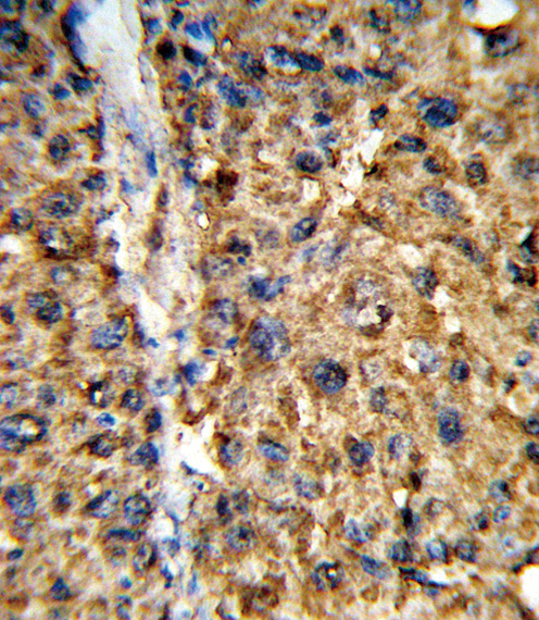 Formalin-fixed and paraffin-embedded human hepatocarcinoma reacted with GSTA2 Antibody , which was peroxidase-conjugated to the secondary antibody, followed by DAB staining. This data demonstrates the use of this antibody for immunohistochemistry; clinical relevance has not been evaluated.