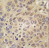 Formalin-fixed and paraffin-embedded human hepatocarcinoma tissue reacted with MARS antibody , which was peroxidase-conjugated to the secondary antibody, followed by DAB staining. This data demonstrates the use of this antibody for immunohistochemistry; clinical relevance has not been evaluated.