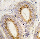 Formalin-fixed and paraffin-embedded human colon carcinoma tissue reacted with MARS2 antibody , which was peroxidase-conjugated to the secondary antibody, followed by DAB staining. This data demonstrates the use of this antibody for immunohistochemistry; clinical relevance has not been evaluated.