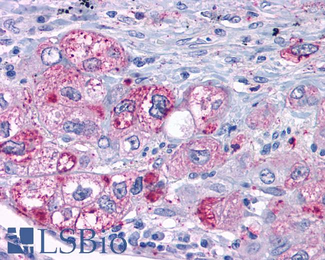Anti-MAS1 / MAS antibody IHC of human Lung, Adenocarcinoma. Immunohistochemistry of formalin-fixed, paraffin-embedded tissue after heat-induced antigen retrieval.