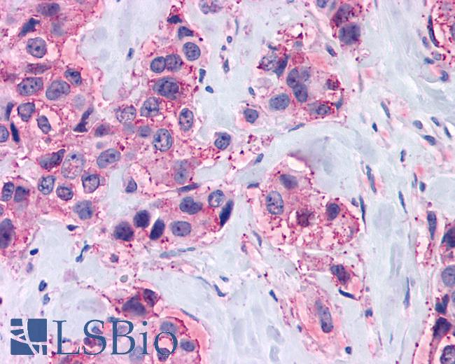 Anti-MAS1 / MAS antibody IHC of human Breast, Carcinoma. Immunohistochemistry of formalin-fixed, paraffin-embedded tissue after heat-induced antigen retrieval.