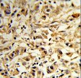 Formalin-fixed and paraffin-embedded human breast carcinoma reacted with MAT2B Antibody , which was peroxidase-conjugated to the secondary antibody, followed by DAB staining. This data demonstrates the use of this antibody for immunohistochemistry; clinical relevance has not been evaluated.