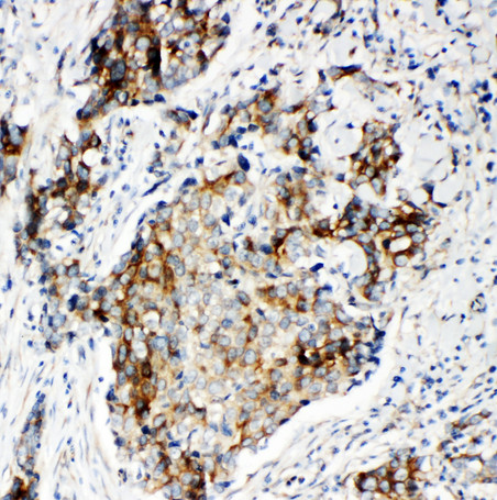 MATN2 / Matrilin 2 antibody. IHC(P): Human Breast Cancer Tissue.