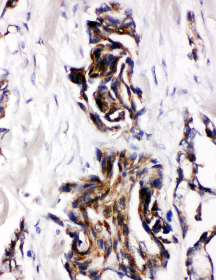MATN2 / Matrilin 2 antibody. IHC(P): Human Breast Cancer Tissue.
