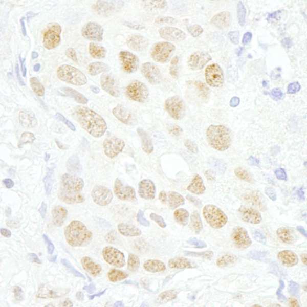Detection of Human MAZ/SAF-1 by Immunohistochemistry. Sample: FFPE section of human breast carcinoma. Antibody: Affinity purified rabbit anti-MAZ/SAF-1 used at a dilution of 1:250.