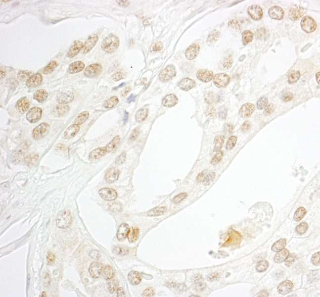 Detection of Human MAZ/SAF-1 by Immunohistochemistry. Sample: FFPE section of human prostate carcinoma. Antibody: Affinity purified rabbit anti-MAZ/SAF-1 used at a dilution of 1:1000 (1 ug/ml). Detection: DAB.