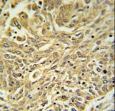 GSTK1 Antibody IHC of formalin-fixed and paraffin-embedded lung carcinoma followed by peroxidase-conjugated secondary antibody and DAB staining.