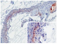 MBL-A (8G6) deposition in developing murine atherosclerotic lesions. Staining of frozen tissue sections with antibody 8G6. Anti-mouse MBL-A at 2 ug/ml (2h, RT). MBL-A was detected on the intima to media border as well as throughout the media (insert). Furthermore, extensive MBL-A deposition was seen at sites of necrosis (upper right corner).