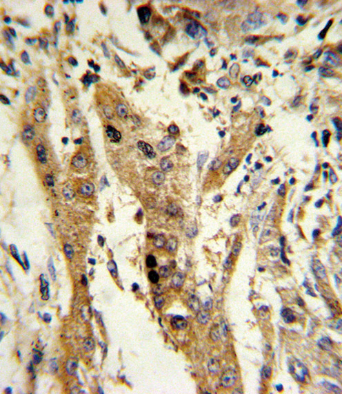 Formalin-fixed and paraffin-embedded human hepatocarcinoma reacted with GSTM1 Antibody , which was peroxidase-conjugated to the secondary antibody, followed by DAB staining. This data demonstrates the use of this antibody for immunohistochemistry; clinical relevance has not been evaluated.
