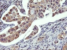 IHC of paraffin-embedded Carcinoma of Human lung tissue using anti-GSTO2 mouse monoclonal antibody.