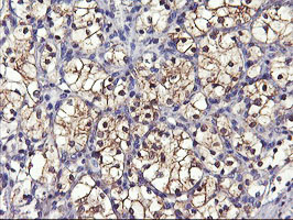IHC of paraffin-embedded Carcinoma of Human kidney tissue using anti-GSTO2 mouse monoclonal antibody.