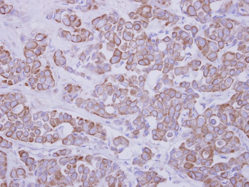 IHC of paraffin-embedded Breast ca, using GTDC1 antibody antibody at 1:250 dilution.