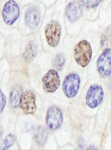 Detection of Human GTF2IRD/TFII-IRD1 by Immunohistochemistry. Sample: FFPE section of human prostate carcinoma. Antibody: Affinity purified rabbit anti-GTF2IRD/TFII-IRD1 used at a dilution of 1:5000 (0.2 Detection: DAB.