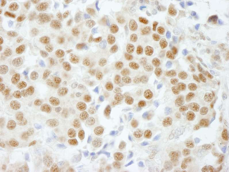Detection of Human GTF3C5/TFIIIC63 by Immunohistochemistry. Sample: FFPE section of human breast carcinoma. Antibody: Affinity purified rabbit anti-GTF3C5/TFIIIC63 used at a dilution of 1:500.