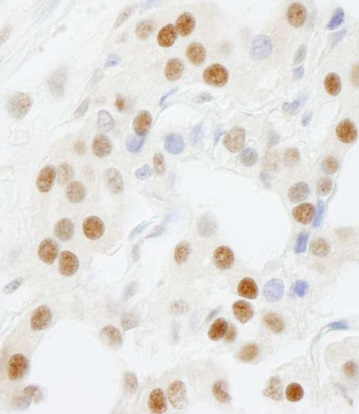 Detection of Human GTF3C5/TFIIIC63 by Immunohistochemistry. Sample: FFPE section of human thyroid carcinoma. Antibody: Affinity purified rabbit anti-GTF3C5/TFIIIC63 used at a dilution of 1:500.