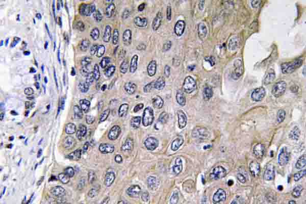 IHC of GCS--1 (D423) pAb in paraffin-embedded human lung carcinoma tissue.