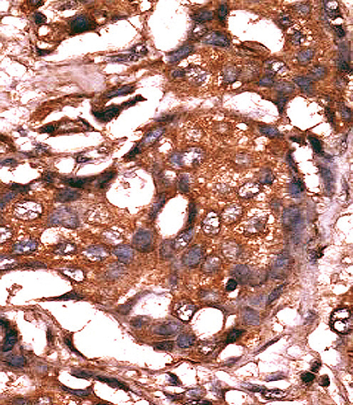 Formalin-fixed and paraffin-embedded human cancer tissue reacted with the primary antibody, which was peroxidase-conjugated to the secondary antibody, followed by AEC staining. This data demonstrates the use of this antibody for immunohistochemistry; clinical relevance has not been evaluated. BC = breast carcinoma; HC = hepatocarcinoma.