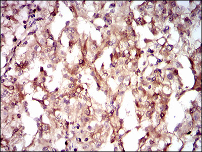 IHC of paraffin-embedded renal cancer tissues using GUCY1A3 mouse monoclonal antibody with DAB staining.