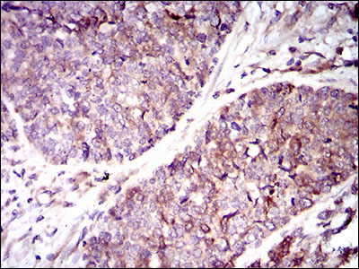 IHC of paraffin-embedded esophageal cancer tissues using GUCY1A3 mouse monoclonal antibody with DAB staining.