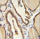 GUCY2D Antibody immunohistochemistry of formalin-fixed and paraffin-embedded human thyroid tissue followed by peroxidase-conjugated secondary antibody and DAB staining.