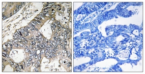 IHC of paraffin-embedded human colon carcinoma tissue, using GUF1 Antibody. The picture on the right is treated with the synthesized peptide.