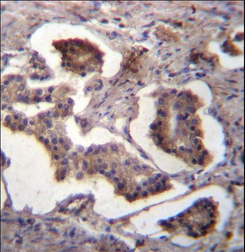 GUF1 Antibody immunohistochemistry of formalin-fixed and paraffin-embedded human prostate carcinoma followed by peroxidase-conjugated secondary antibody and DAB staining.