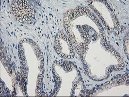 IHC of paraffin-embedded Carcinoma of Human prostate tissue using anti-GUK1 mouse monoclonal antibody. (Heat-induced epitope retrieval by 10mM citric buffer, pH6.0, 100C for 10min).